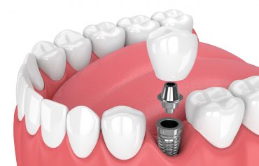 İmplant Tedavisi