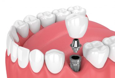 Implant Treatment