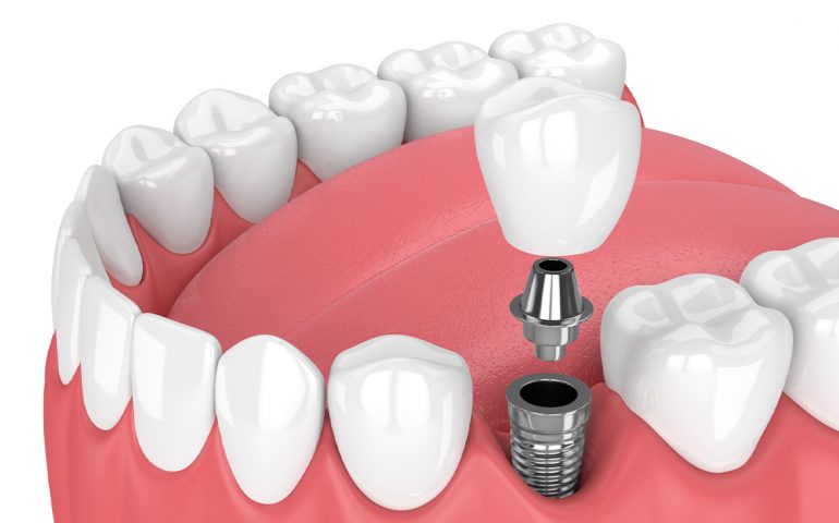 implant diş