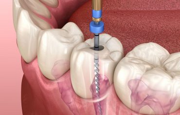 Root Canal Treatment