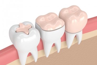 Porcelain Fillings